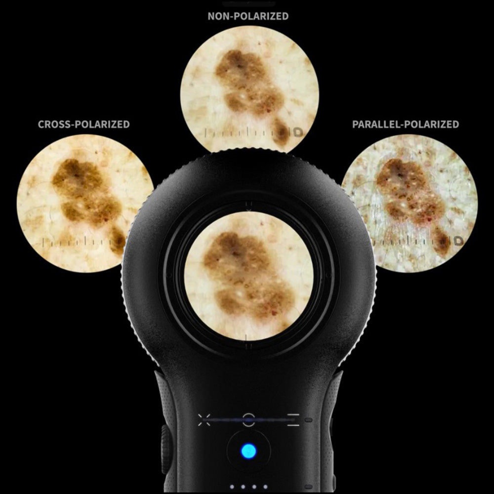 DermLite V PLUS Dermatoscope with PigmentBoost, DermLite 5 PLUS. MPN: DL5PLUS - Image 3
