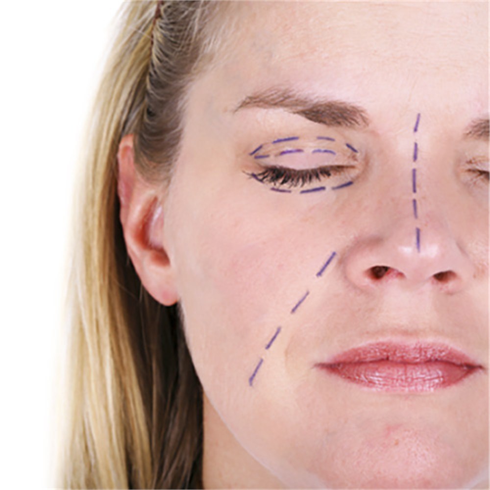 Surgical Marker, Sterile BlephMarker, 100 per case. MPN: 1424SR-100 - Image 2